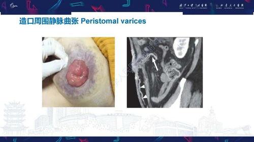 《超级胬肉系统：探索眼部健康与治疗新方法》